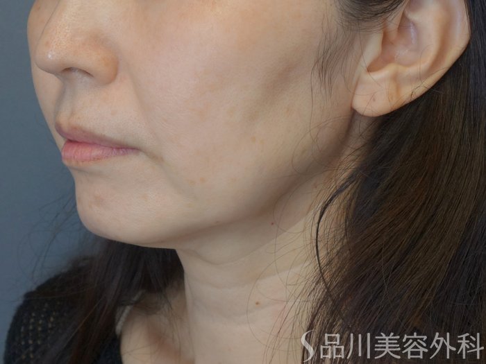 症例NO.71924のBEFORE写真