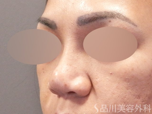 症例NO.67917のBEFORE写真