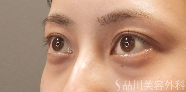 症例NO.74433のBEFORE写真