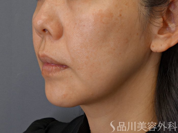 症例NO.74792のBEFORE写真