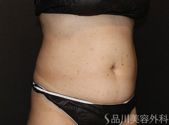 症例NO.71859のBEFORE写真