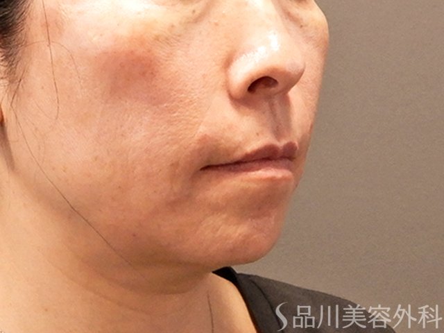 症例NO.70858のAFTER写真
