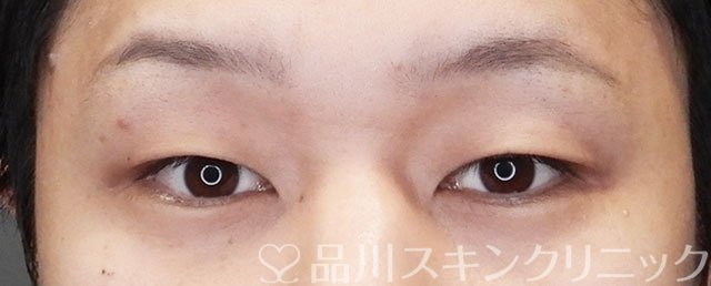 症例NO.73025のBEFORE写真