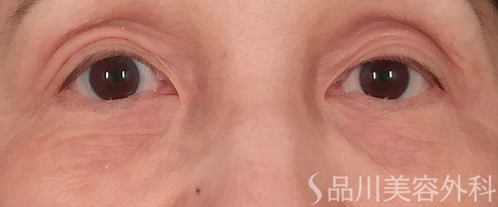 症例NO.70624のBEFORE写真