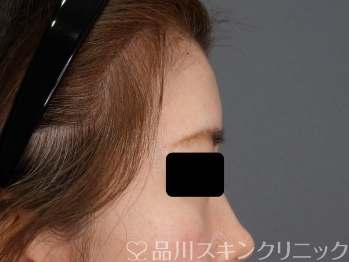 症例NO.73342のAFTER写真