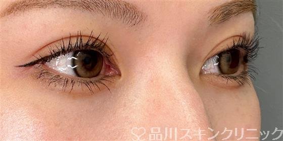 症例NO.60909のAFTER写真