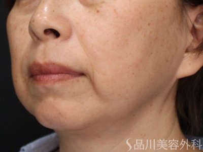 症例NO.74865のBEFORE写真