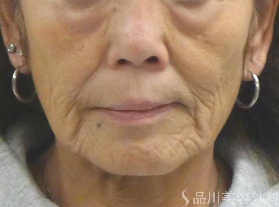 症例NO.49998のBEFORE写真