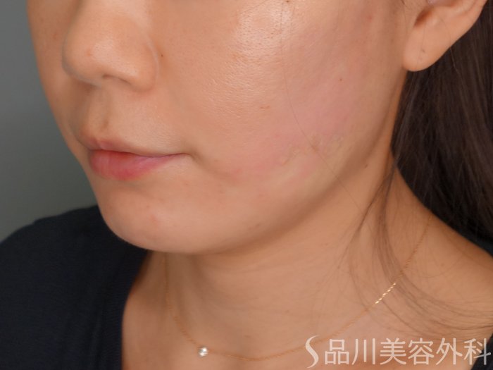 症例NO.70061のAFTER写真