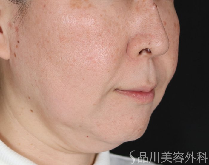 症例NO.72498のBEFORE写真