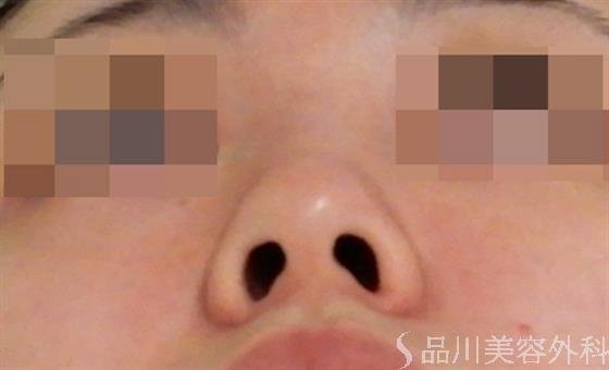 症例NO.38736のBEFORE写真