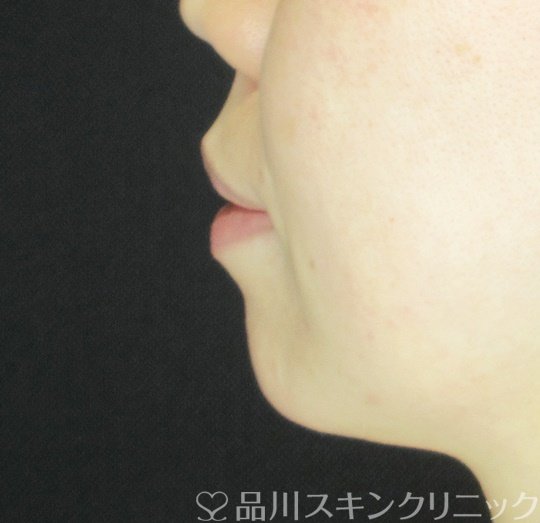 症例NO.70048のBEFORE写真