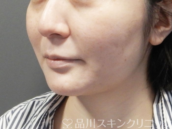 症例NO.73382のAFTER写真