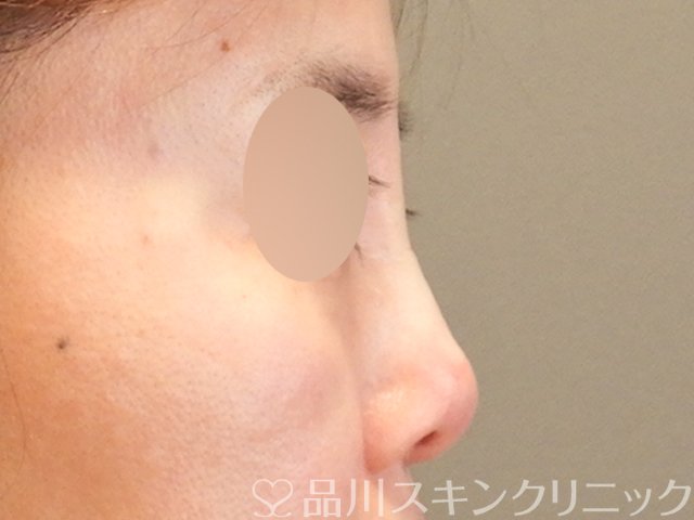 症例NO.66183のAFTER写真