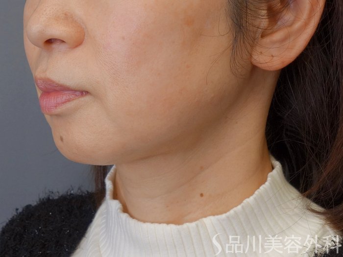 症例NO.72873のBEFORE写真