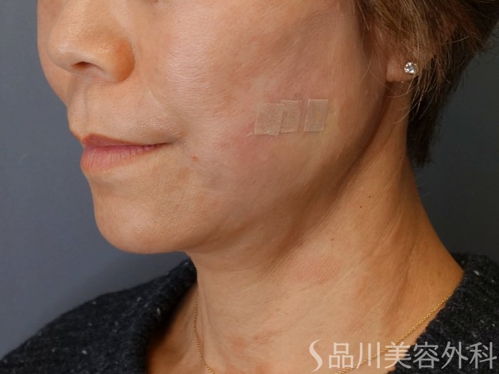 症例NO.72749のAFTER写真