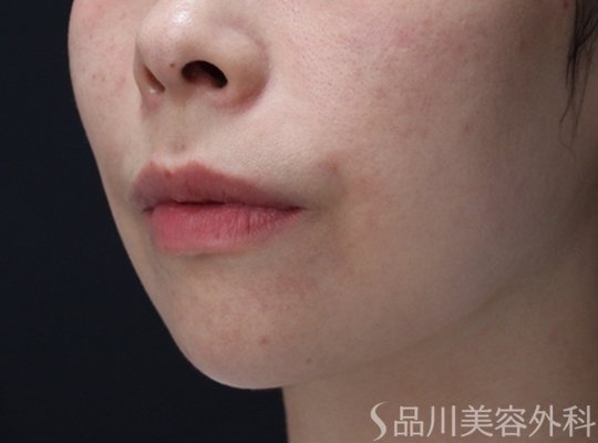 症例NO.71618のBEFORE写真