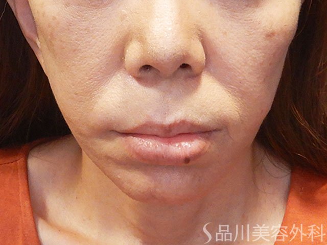 症例NO.71935のAFTER写真