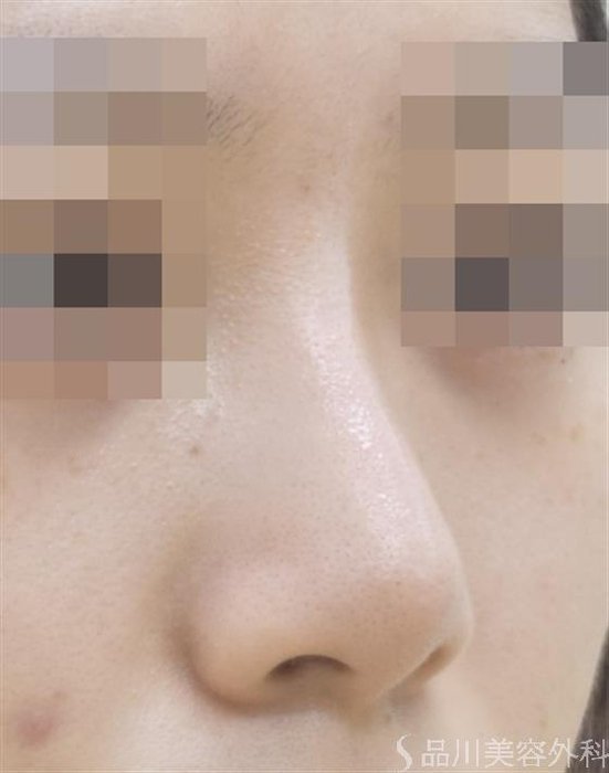 症例NO.44619のAFTER写真