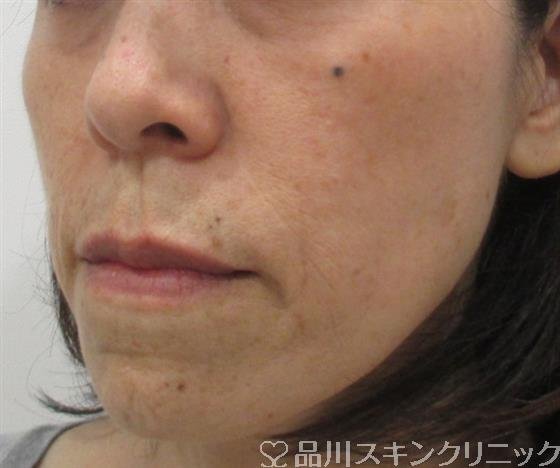 症例NO.30069のAFTER写真