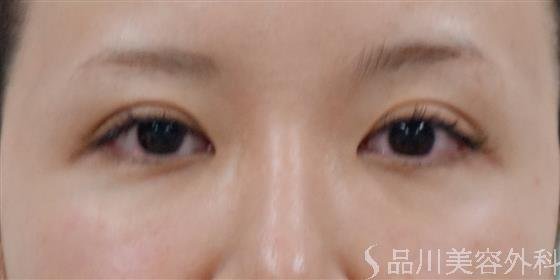 症例NO.39657のBEFORE写真