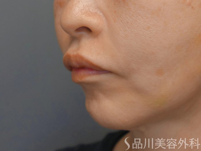 症例NO.71442のAFTER写真