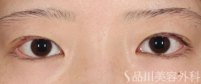 症例NO.72134のAFTER写真