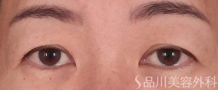症例NO.70394のBEFORE写真