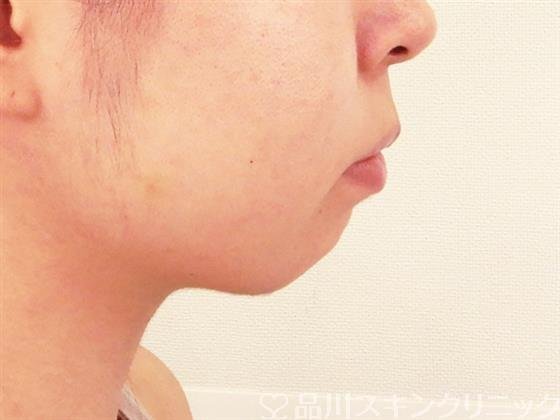 症例NO.61039のBEFORE写真
