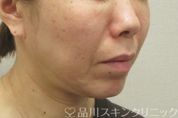 症例NO.75110のBEFORE写真
