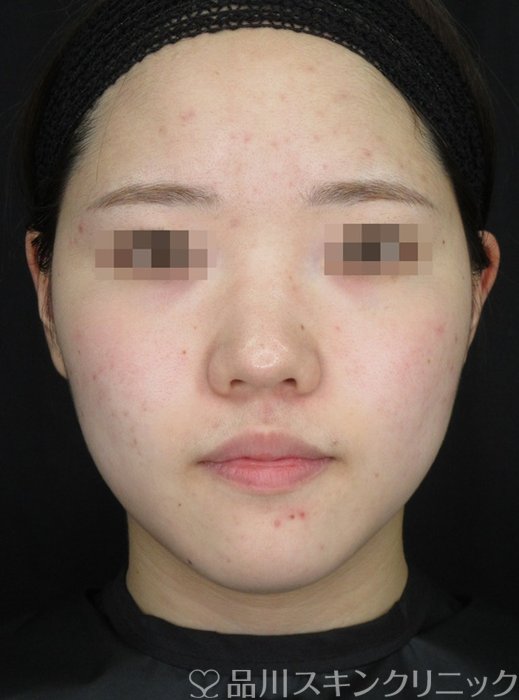 症例NO.72137のBEFORE写真