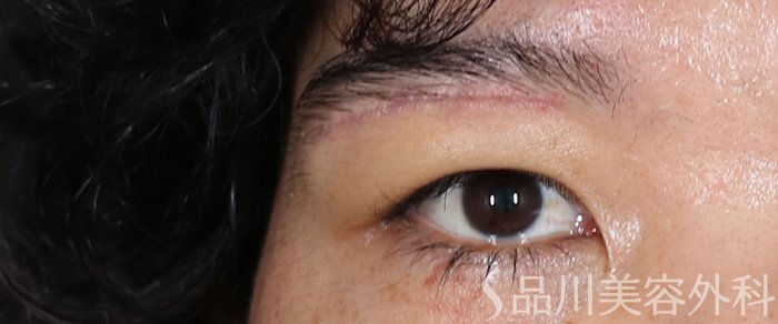 症例NO.71263のAFTER写真