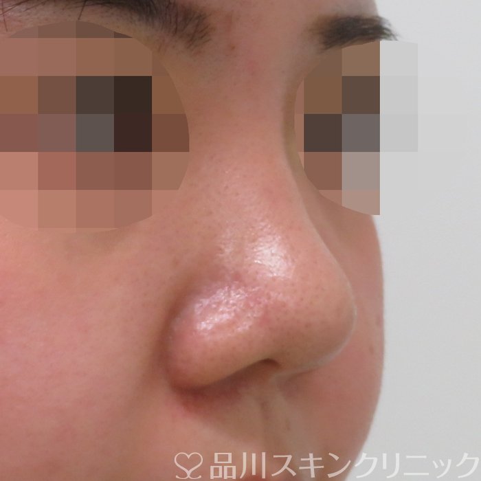 症例NO.70202のBEFORE写真