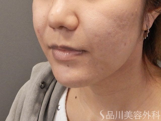 症例NO.74604のBEFORE写真