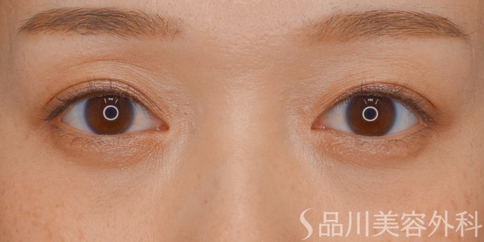 症例NO.73568のAFTER写真