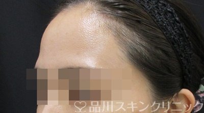 症例NO.66705のBEFORE写真