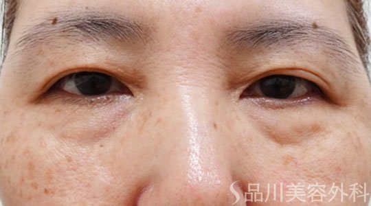 症例NO.69437のBEFORE写真