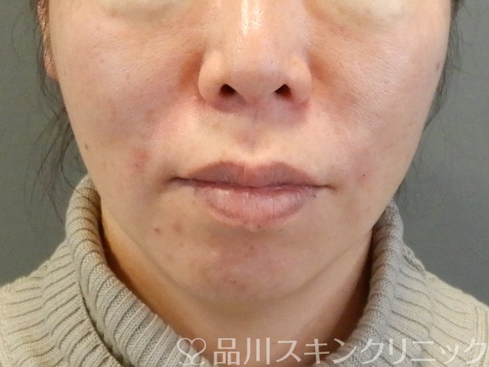 症例NO.63525のAFTER写真