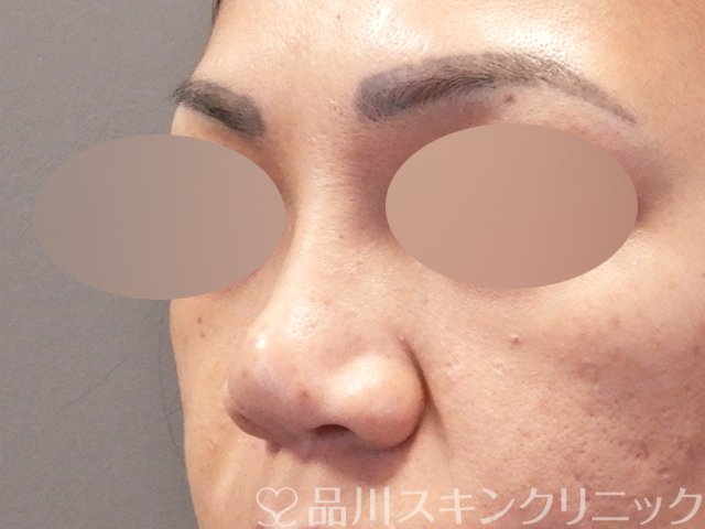 症例NO.67917のBEFORE写真