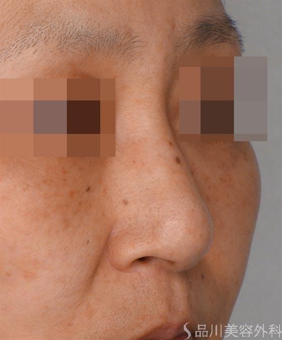 症例NO.47402のBEFORE写真