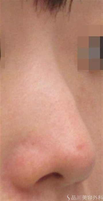 症例NO.19199のBEFORE写真