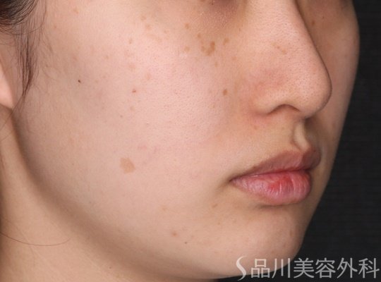 症例NO.75259のBEFORE写真