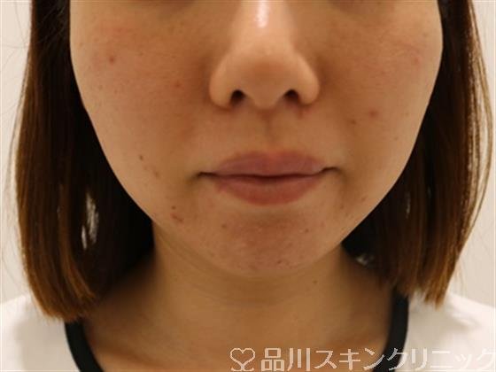 症例NO.41244のAFTER写真