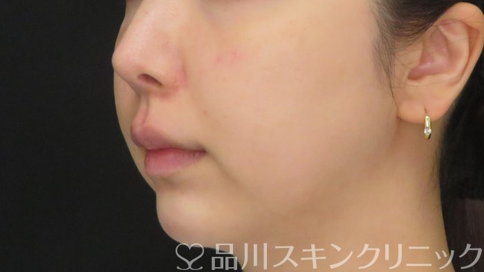 症例NO.71769のAFTER写真