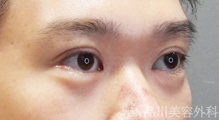 症例NO.71526のAFTER写真