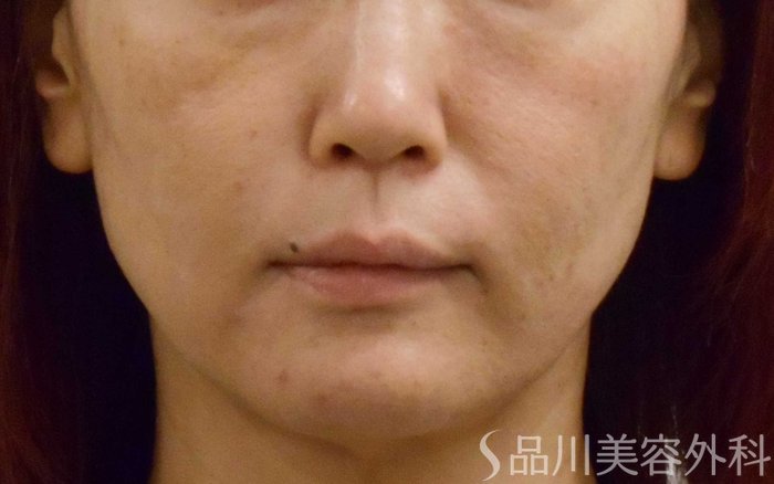 症例NO.67776のBEFORE写真