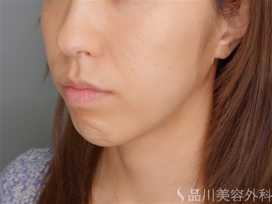 症例NO.51427のBEFORE写真