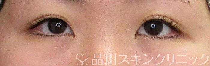 症例NO.68440のBEFORE写真