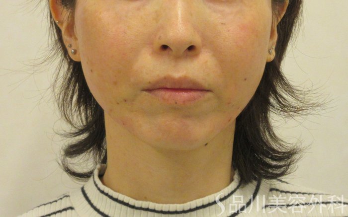 症例NO.72917のAFTER写真