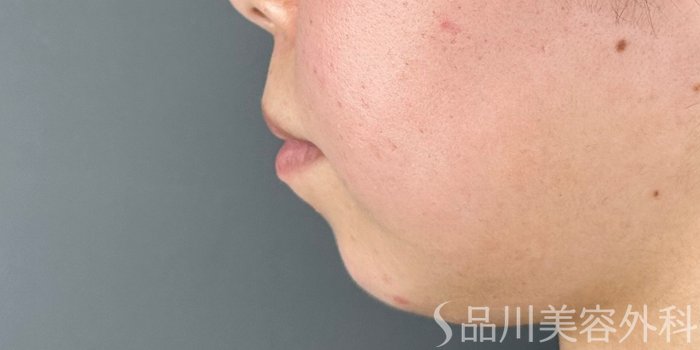 症例NO.72415のBEFORE写真